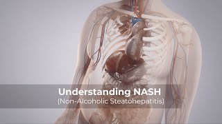 Understanding NASH NonAlcoholic Steatohepatitis [upl. by Latimer]