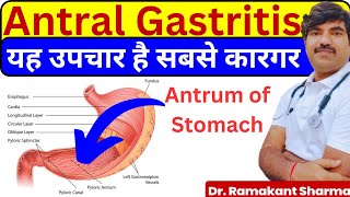 Antral Gastritis Causes Symptoms and Effective Treatments drramakantsharma7 [upl. by Farris]