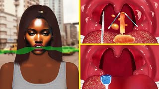 Treatment ASMR tonsils stone removed  Kinshasa Hospital tonsils stone  BLK ASMR [upl. by Rorry]