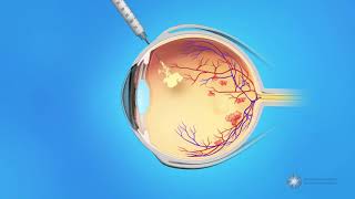 Eye Injections for Central Retinal Vein Occlusion CRVO [upl. by Miguela]