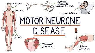 Understanding Motor Neurone Disease Amyotrophic Lateral Sclerosis [upl. by Massab]