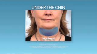 Eliminate your double chin with CoolSculpting [upl. by Nyvrem872]