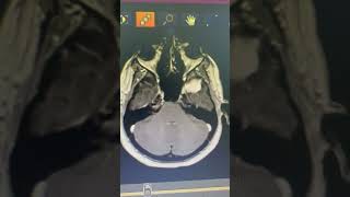 meningioma resection [upl. by Robinet]