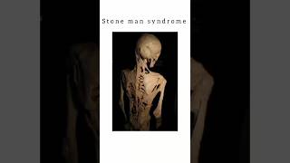 Stone Man Syndrome — English kattrucate medicalreels stoneman syndrome muscle pain swelling [upl. by Corliss]