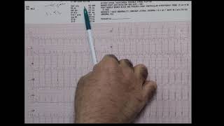 Left Posterior fascicular VT [upl. by Elaine322]