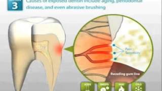 Demineralized Tooth Enamel Dynamics of Treatment [upl. by Htebzil]