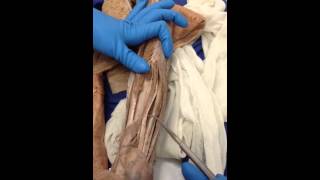 Human cadaver extensor muscles arm [upl. by Enicnarf]