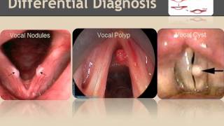 Vocal nodules Inservice [upl. by Adieren]