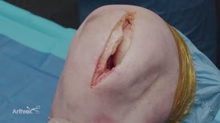 Treatment of a Medial Femoral Condyle Osteochondral Defect Using an Osteochondral Allograft [upl. by Ardied]