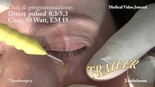 8 Trattamento di Xantelasma con il resurfacing timedchirurgico [upl. by Oiramrej]