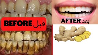 مرحبا هده الوصفة مجربة ومضمونة لازالة التسوس وصفةإزالةالتسوس وصفةتبييضالاسنان Teeth whitening [upl. by Sherm]