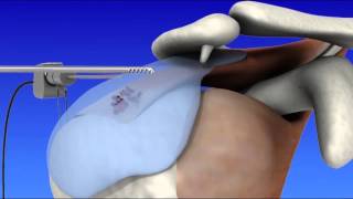 Shoulder Arthroscopy [upl. by Vida]