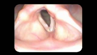 Vocal cord paralysis with nodules [upl. by Ityak]