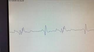 Complex repetitive discharge [upl. by Jay352]