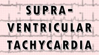 Supraventricular Tachycardia [upl. by Bourn]