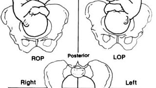 اسهل طريقة لتحديد malposition and malpresentation  مادة توليد obstetrics [upl. by Ahseenal]