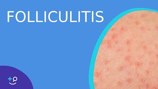 Folliculitis  Daily Dos of Dermatology [upl. by Ynnot]