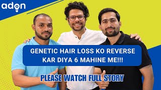 Genetic hair loss reversal 6 months by adon hair care [upl. by Kinney]