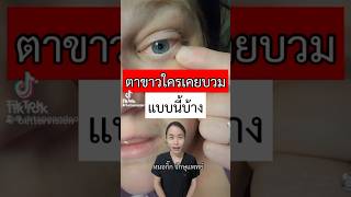 ตาขาวใครเคยบวมแบบนี้บ้าง หมอกิ๊ก จักษุแพทย์ ophthalmologist เยื่อบุตาขาวบวม chemosis eye ตา [upl. by Kissie]