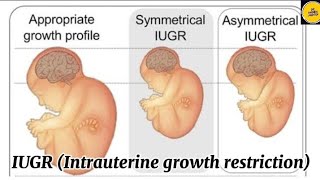 Intrauterine growth restriction causes  IUGR complete explanation [upl. by Lower]