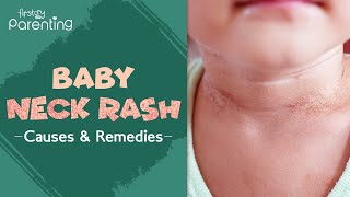 Neck Rash in Babies  Causes Signs and Treatment [upl. by Audwen801]