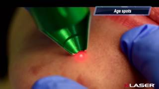 KLASER BLUE DERMA 445nm  Pigmented Lesions Removal Age Spot Lentigos LiverSpots [upl. by Akcirehs]