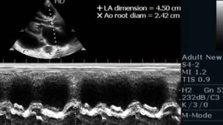 LARGE PERICARDIAL EFFUSION  ECHOCARDIOGRAPHY SERIES BY DRANKURKCHAUDHARI [upl. by Torbart543]