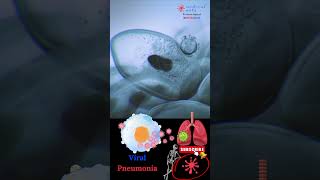 Pneumonia  Respiratory infection  Viral pneumonia  Medical Arts shorts [upl. by Yvaht540]