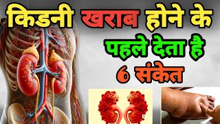 किडनी खराब होने के लक्षण । Kidney failure symptoms CKD [upl. by Nohsad]