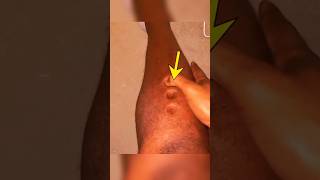 সাবধান edema 🤯 facts science ytshorts amazingfacts edema [upl. by Philo]