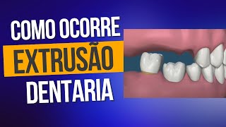 Como ocorre a extrusão dentaria dralexguedes [upl. by Irac]