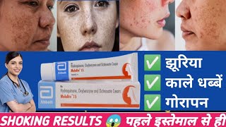 Melalite 15 cream review  चेहरा को गोरा करे  melalite cream  Melalite Cream [upl. by Rape]