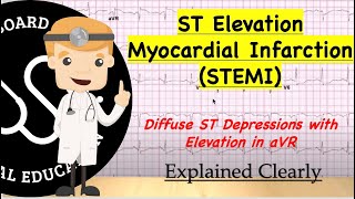 ST Elevation Myocardial Infarction Equivalent  ST Elevation In aVR With Diffuse ST Depressions [upl. by Ajiak483]