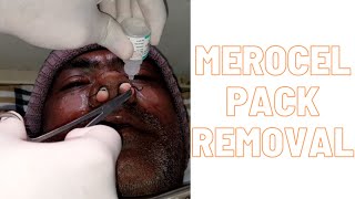 Merocel pack removal [upl. by Ydnic]