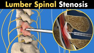 MILD procedure of lumber spinal stenosis 3D animation [upl. by Yahs]