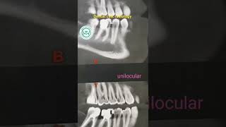 Dental cyst radiology حويصلات الفكين [upl. by Sualocin]