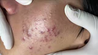 Blackheads amp Whiteheads Removal New 2024 Acne Treatment With Nhat Bang [upl. by Brander]