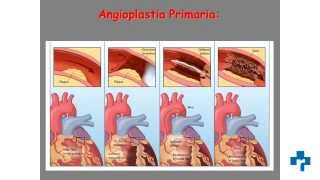 Cateterismo cardiaco y angioplastia coronaria técnicas que salvan vidas [upl. by Gorton]