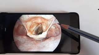 Anatomy of Laryngopharynx HypopharynxENT [upl. by Geier]