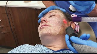 Full Face Fractional CO2 Laser Resurfacing for Wrinkles and Skin Tightening [upl. by Patsy]