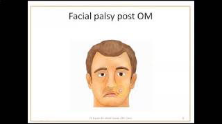 Complications of Otitis Media 2 Mastoiditis and facial palsy [upl. by Mirabelle585]