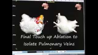 Atrial Fibrillation Ablation part 3 of 3 How to Perform Pulmonary Vein Isolation [upl. by Nahgam]