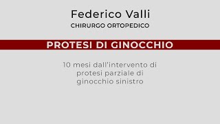 Protesi di Ginocchio 10 mesi dalloperazione di protesi parziale [upl. by Eitsrik176]