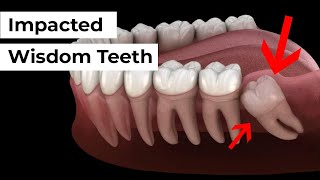 Impacted Wisdom Tooth Removal [upl. by Demmahum]