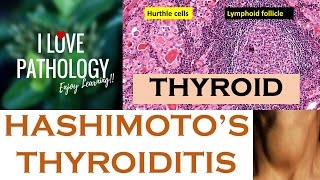 HASHIMOTOS THYROIDITIS Etiopathogenesis Morphology amp Complications [upl. by Ydnis771]