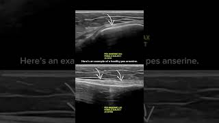 ultrasound Guided Interventions Healthy Images Pes Anserine [upl. by Ainatnas59]