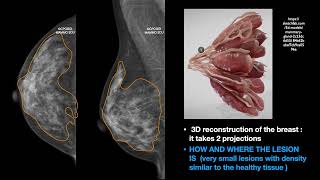 THE MAMMOGRAPHY FINDINGS PART ONE HOW AND WHERE [upl. by Urba]