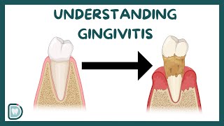 Understanding Gingivitis Causes Risk Factors Diagnosis and Treatment  Complete Guide [upl. by Lingwood]