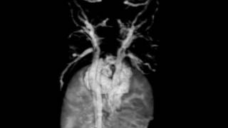 Mouse Embryo Heart and Blood Vessels  MRI [upl. by Newcomer]