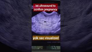 Gestational sac  Early pregnancy कैसे दिखती है [upl. by Ettenawtna]